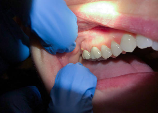 Best Knocked-Out Tooth Emergency  in Seffner, FL